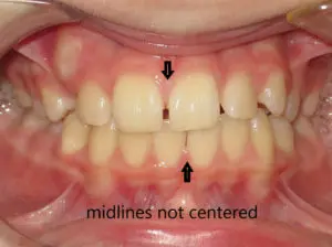 Braces Before and After Pictures in Virginia Beach, VA