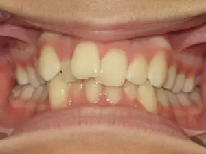 Braces Before and After Pictures in Virginia Beach, VA