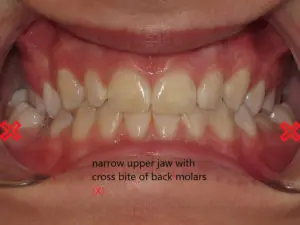Braces Before and After Pictures in Virginia Beach, VA