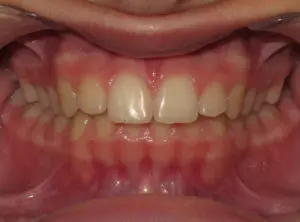 Invisalign Before and After Pictures in Virginia Beach, VA