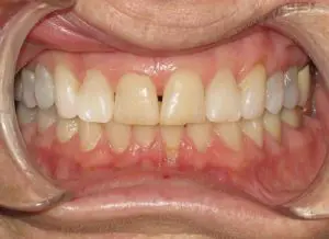 Invisalign Before and After Pictures in Virginia Beach, VA
