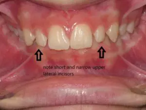 Invisalign Before and After Pictures in Virginia Beach, VA