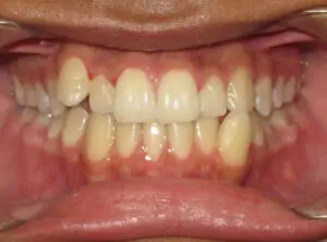 Braces Before and After Pictures in Virginia Beach, VA