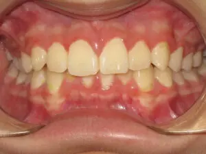 Invisalign Before and After Pictures in Virginia Beach, VA