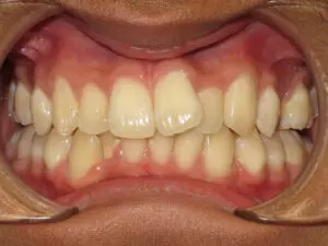 Invisalign Before and After Pictures in Virginia Beach, VA