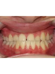 Surgery Before and After Pictures in Virginia Beach, VA