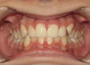 Invisalign Before and After Pictures Virginia Beach, VA