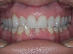Invisalign Before and After Pictures Virginia Beach, VA