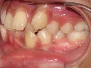 Braces Before and After Pictures Virginia Beach, VA