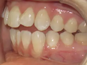 Invisalign Before and After Pictures in Virginia Beach, VA