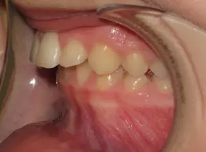 Invisalign Before and After Pictures in Virginia Beach, VA