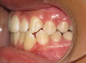 Braces Before and After Pictures in Virginia Beach, VA