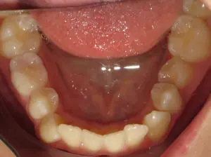 Braces Before and After Pictures in Virginia Beach, VA