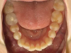 Invisalign Before and After Pictures in Virginia Beach, VA