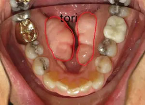 Invisalign Before and After Pictures in Virginia Beach, VA