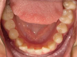 Braces Before and After Pictures Virginia Beach, VA