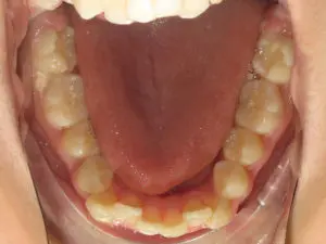 Braces Before and After Pictures in Virginia Beach, VA