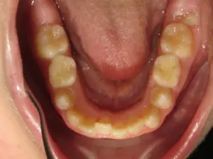 Braces Before and After Pictures in Virginia Beach, VA