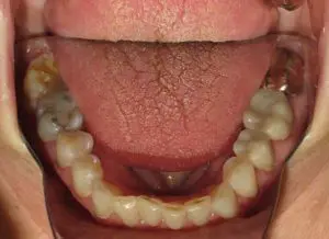 Invisalign Before and After Pictures in Virginia Beach, VA