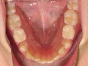 Invisalign Before and After Pictures in Virginia Beach, VA