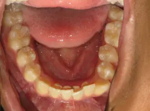 Braces Before and After Pictures in Virginia Beach, VA