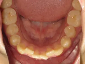 Invisalign Before and After Pictures in Virginia Beach, VA