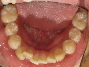 Invisalign Before and After Pictures in Virginia Beach, VA