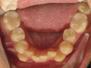 Braces Before and After Pictures Virginia Beach, VA