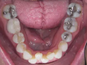 Invisalign Before and After Pictures Virginia Beach, VA