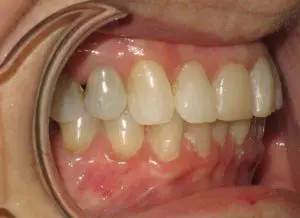 Invisalign Before and After Pictures in Virginia Beach, VA