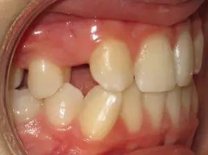 Braces Before and After Pictures in Virginia Beach, VA