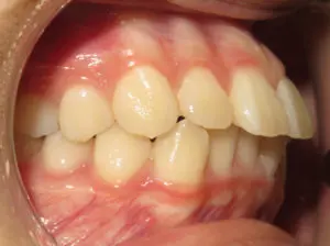 Braces Before and After Pictures in Virginia Beach, VA