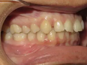 Braces Before and After Pictures in Virginia Beach, VA