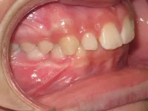 Invisalign Before and After Pictures in Virginia Beach, VA