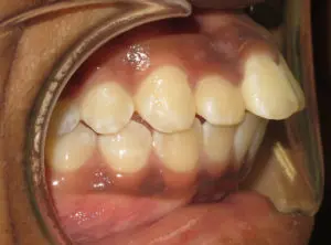 Surgery Before and After Pictures in Virginia Beach, VA