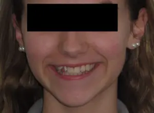 Invisalign Before and After Pictures Virginia Beach, VA