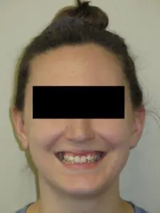 Invisalign Before and After Pictures in Virginia Beach, VA