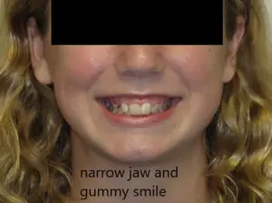 Braces Before and After Pictures in Virginia Beach, VA