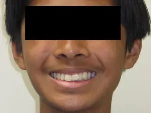 Invisalign Before and After Pictures in Virginia Beach, VA