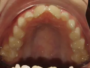 Braces Before and After Pictures Virginia Beach, VA