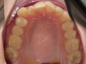 Invisalign Before and After Pictures Virginia Beach, VA