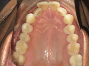 Invisalign Before and After Pictures Virginia Beach, VA