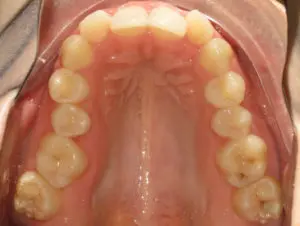 Invisalign Before and After Pictures in Virginia Beach, VA