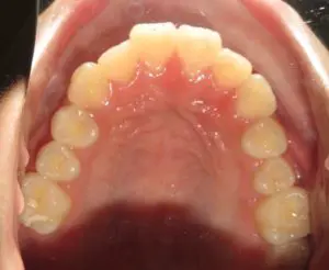 Braces Before and After Pictures in Virginia Beach, VA