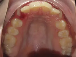 Braces Before and After Pictures in Virginia Beach, VA