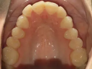 Invisalign Before and After Pictures in Virginia Beach, VA