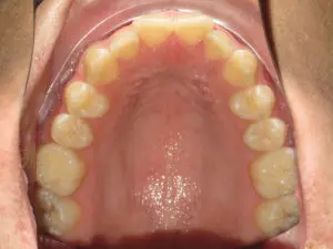 Invisalign Before and After Pictures in Virginia Beach, VA