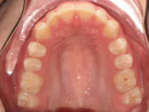 Braces Before and After Pictures in Virginia Beach, VA