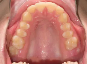 Invisalign Before and After Pictures in Virginia Beach, VA