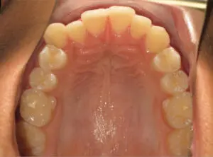 Braces Before and After Pictures in Virginia Beach, VA